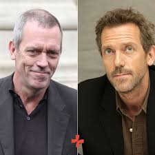 hugh laurie hair transplant