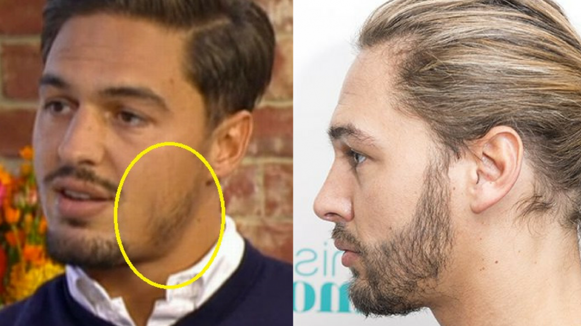 Mario Falcone beard transplant! Celebrities hair transplants