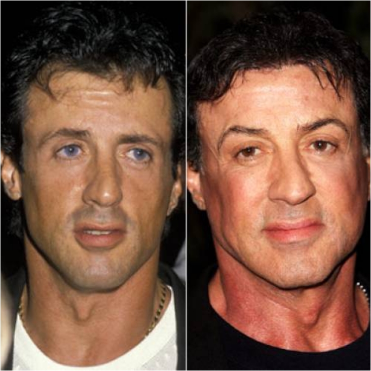 sylvester stallone hair transplant