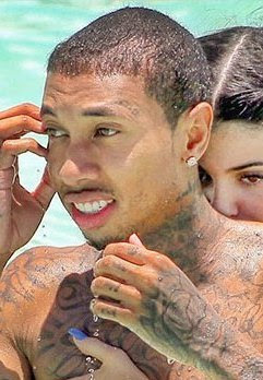 tyga hairline transplant.