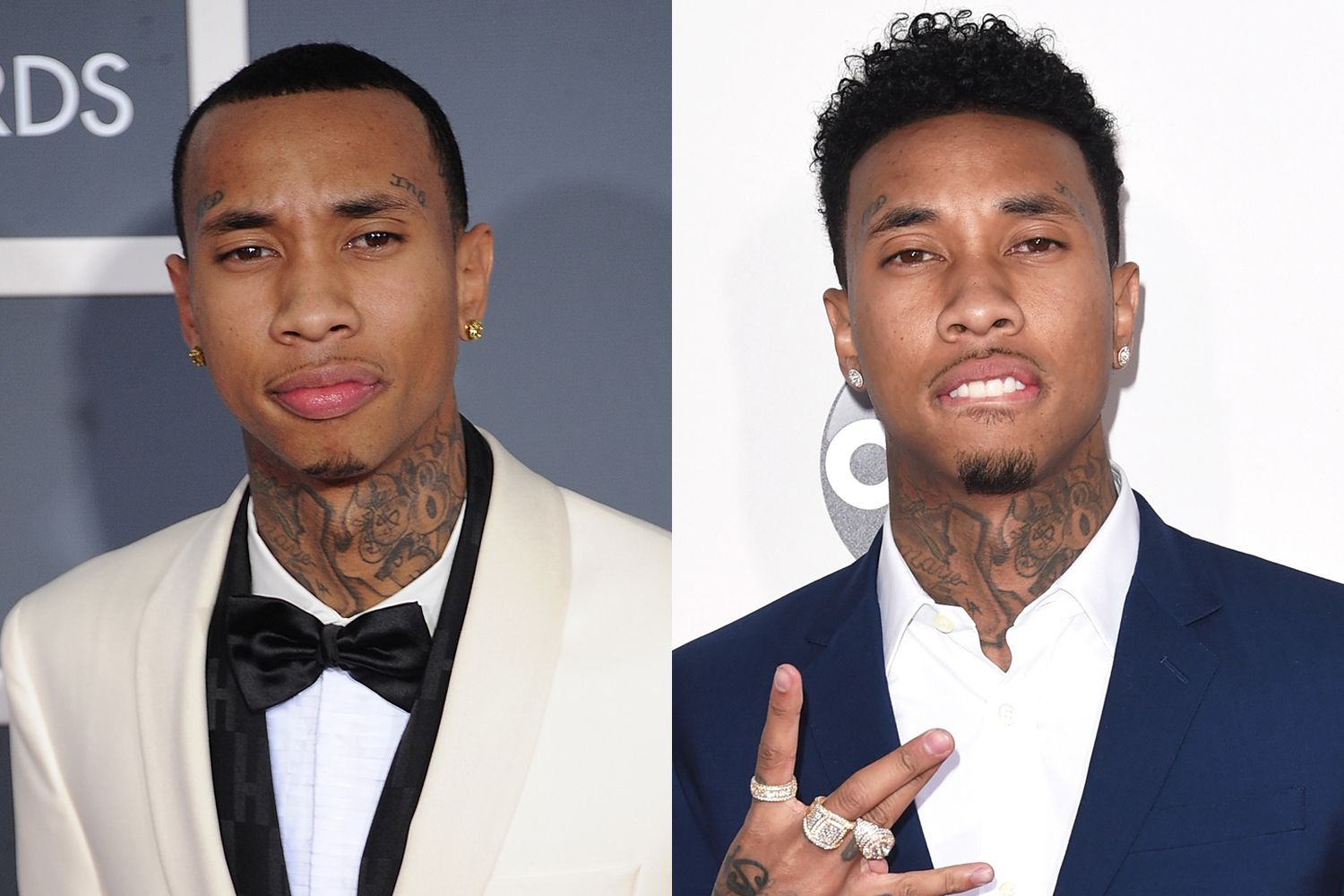 Evidence Points to Tyga Hair Transplant: The Highest Possibility.