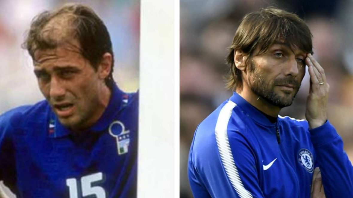 The amazing change from Antonio Conte bald to full set of hair ...