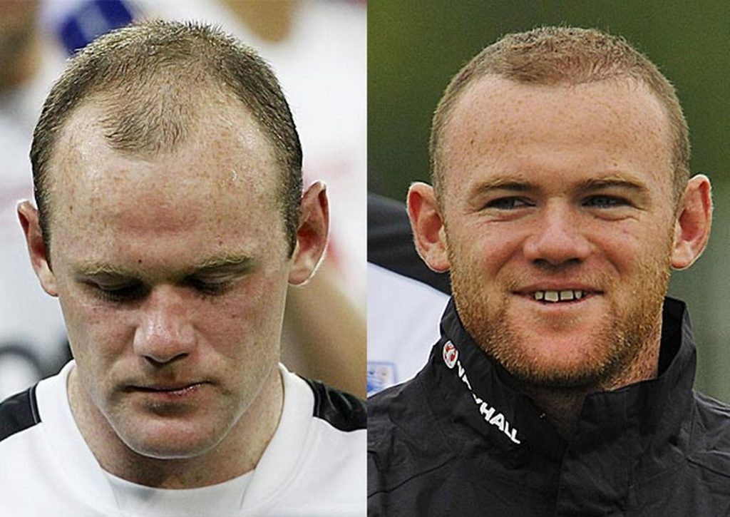 wayne rooney hair plugs