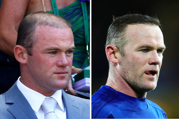 rooney hair transplant before after