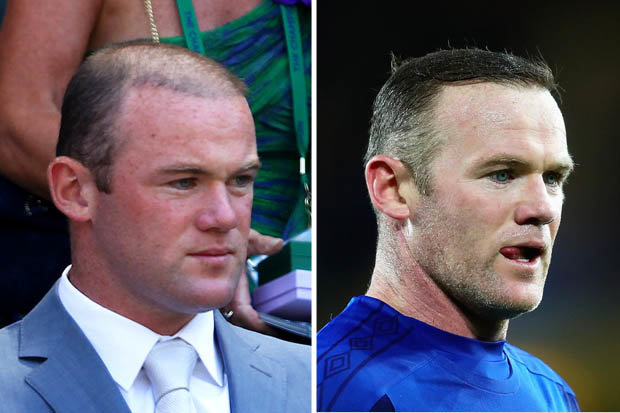 Wayne-Rooney-hair-transplant-before-and-after - Celebrities hair