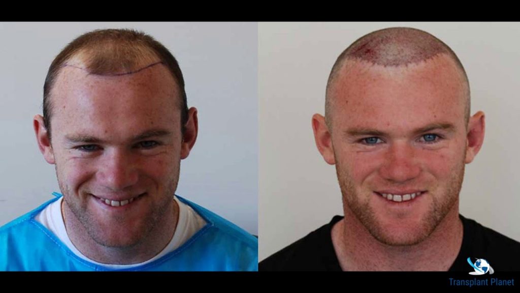 wayne rooney before and after